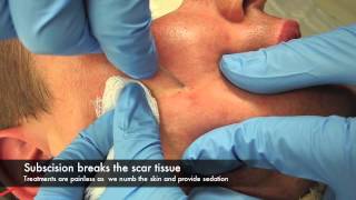 Subscision and surgery for acne scars [upl. by Tsew]