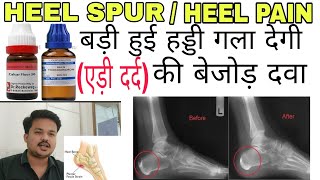 HEEL SPURCALCANEAL SPUR एड़ी दर्द ki bejod homeopathic dawaHeel pain ki होम्योपैथिक दवा spur [upl. by Ram]