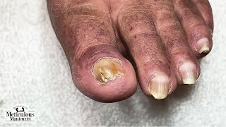 Pedicure Care Creates Significant Progress in Troubled Toenails [upl. by Annadroj]