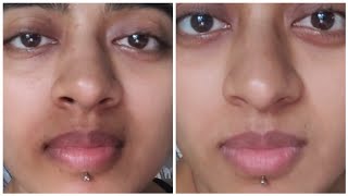 How I ACTUALLY got Rid of Pigmentation Around my Mouth  Pigmentation Treatment For Mouth Darkness [upl. by Kendry402]