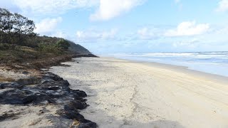 Suspected Irukandji jellyfish sting on Qlds Fraser Island [upl. by Grannia]