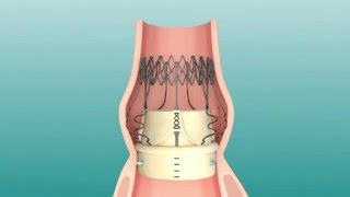 Perceval Sutureless Heart Valve Replacement Implant Animation [upl. by Atilal242]