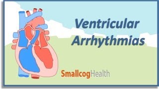 Ventricular Arrhythmias [upl. by Kleinstein]