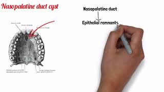 FISSURAL CYSTS  ORAL PATHOLOGY [upl. by Nnahs495]