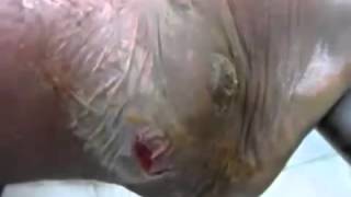 Big Blackhead Squeezed Pimple Removal Cyst Treatment 2015 [upl. by Latouche]