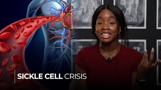 Sickle Cell Crisis Causes Symptoms and Prevention Strategies [upl. by Gitel]