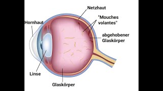 Mouches volantes  Glaskörpertrübung  Aurachirurgie [upl. by Ernst46]