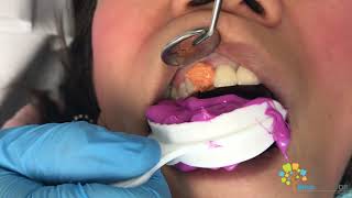 Cosmetic Dental Crown Procedure  All Ceramic Crown [upl. by Lemrac665]