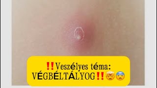 ‼️Veszélyes téma VÉGBÉLTÁLYOG‼️🤯😨 [upl. by Ailices936]