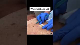 Blackheads Popping amp Blackhead Removal Videos 2022 [upl. by Merralee161]