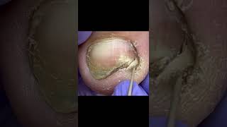 Mottled Onychomycosis Treatment Be Very Careful [upl. by Nodababus]