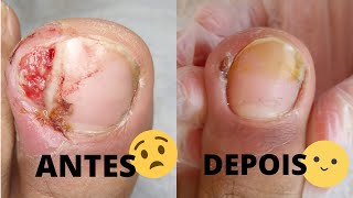 UNHA ENCRAVADA TRATAMENTO COMPLETO  ANTES E DEPOIS GRANULOMA PIOGENICO [upl. by Valleau]