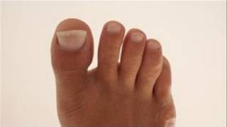 How To Remedy Yellow Toenails [upl. by Vonnie]