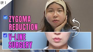 SUB Zygoma and Jawline Reduction Plastic Surgery Review VLOG in KOREA  SLIM amp VLINE FACE [upl. by Ycat206]