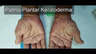 Palmoplantar Keratoderma [upl. by Solotsopa512]