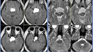 Preoperative Imaging  Craniopharyngioma  UCLA Pituitary Tumor Program [upl. by Jaime]