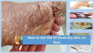 How to Get Rid of Dead Dry Skin on Feet [upl. by Pritchard]