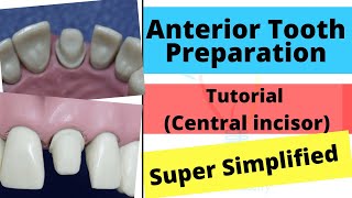 Anterior Crown Preparation  Demonstration Super Easy [upl. by Yhtomit]