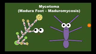 7 Mycetoma الورم الفطري [upl. by Akselav]