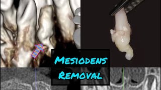 Palatal Mesiodens Removal [upl. by Eustashe]