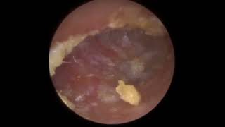 885  Painful Fungal Infected Keratosis Obturans Removal [upl. by Kcirdnekel]