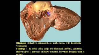 Pathology Second  Dr Nafea  Thrombosis 1 [upl. by Ahen]