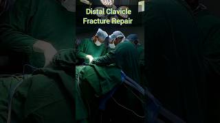 Distal Clavicle Fracture Repair claviclefracture [upl. by Cormac]