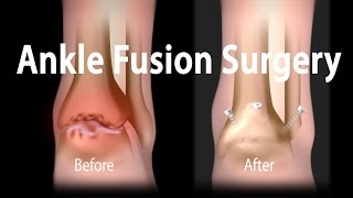 Ankle Fusion Surgery Animation [upl. by Genet522]