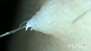 Best compilation of ingrown hair plucking Scabs and gross hairs too [upl. by Ricarda688]