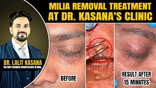 Milia Removal Treatment at DrKasanas Clinic [upl. by Gally]