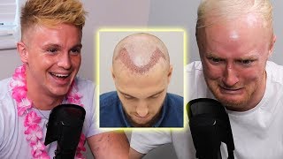 Exposing Theos Hair Transplant Secrets [upl. by Aicnatsnoc]