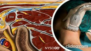 ULTRASOUND GUIDED CERVICAL PLEXUS BLOCK FOR CLAVICLE SURGERY [upl. by Ondine721]