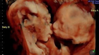 MomToBe Shocked When Her Twins Were Caught Kissing On Sonogram [upl. by Earla]