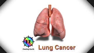 Lung Cancer  Symptom Causes amp Diagnosis Finding Earth [upl. by Irakab]