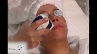 MeDioStar NeXT  Training video for hair removal face from Asclepion [upl. by Eissirk240]