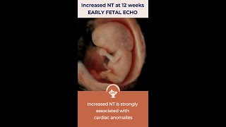 Early Fetal Echocardiography for fetuses with increased NT by Dr Fred Ushakov [upl. by Verge]