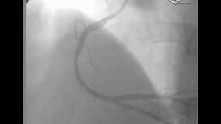 angioplastia en Infarto Agudo [upl. by Gnus259]