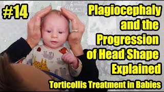 14 Plagiocephaly and the Progression of Head Shape Explained Torticollis Treatment in Babies [upl. by Niro31]