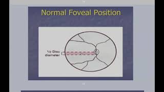 strabismus revision part 13 [upl. by Yhtamit]