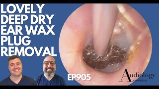 LOVELY DEEP DRY EAR WAX REMOVAL  EP905 [upl. by Alyahc]