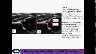 Developmental Dysplasia of the Hip  Ultrasound [upl. by Leopold]