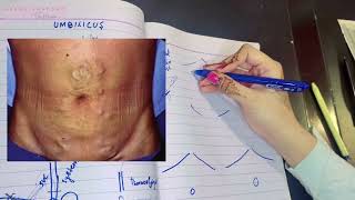 Umbilicus  Portocaval anastomoses  Caput Medusae  SVC IVC Obstruction  Watershed Line [upl. by Ayam]