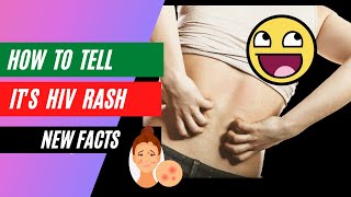 how to tell HIV rash  clear confusion [upl. by Eniamraj]