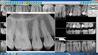 DEXIS™ Imaging Suite  Toolbar Overview Part Three [upl. by Atiuqnahs620]