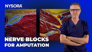 Sciatic  Femoral Nerve Blocks for AKA Amputation [upl. by Newell239]