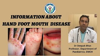 Information about Hand Foot amp Mouth Disease II Awareness II Prevention II Treatment II DMCH [upl. by Nytsrik]