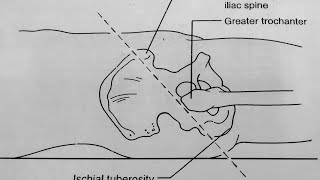 Nelatons line  Special test to check hip dislocation or coxa vara [upl. by Kreitman772]