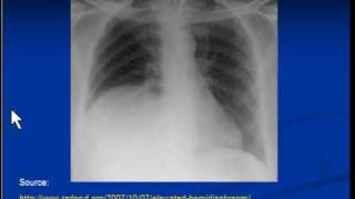 Chest xray interpretation Raised hemidiaphragm [upl. by Melburn]