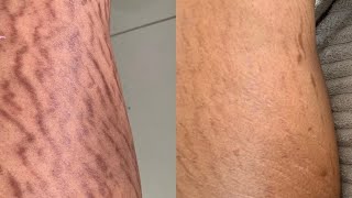 14 days stretch mark removal [upl. by Gillespie]