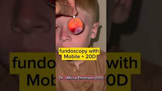 Fundoscopy with 20D  Mobile optometrist [upl. by Enelaehs]